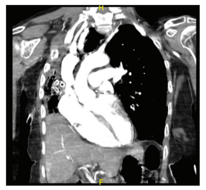 Surgical Management of an Intraparenchymal Chest Tube with ...